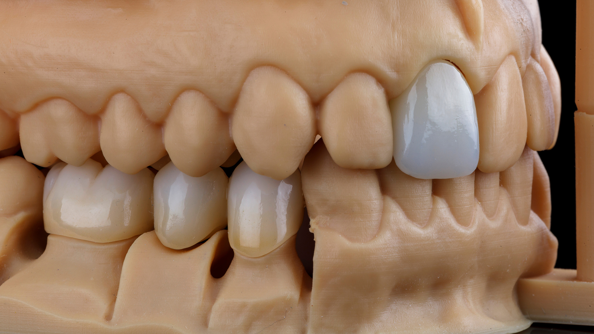 Mountain View Dentistry | Fluoride Treatment, Crowns  amp  Caps and Dental Bridges