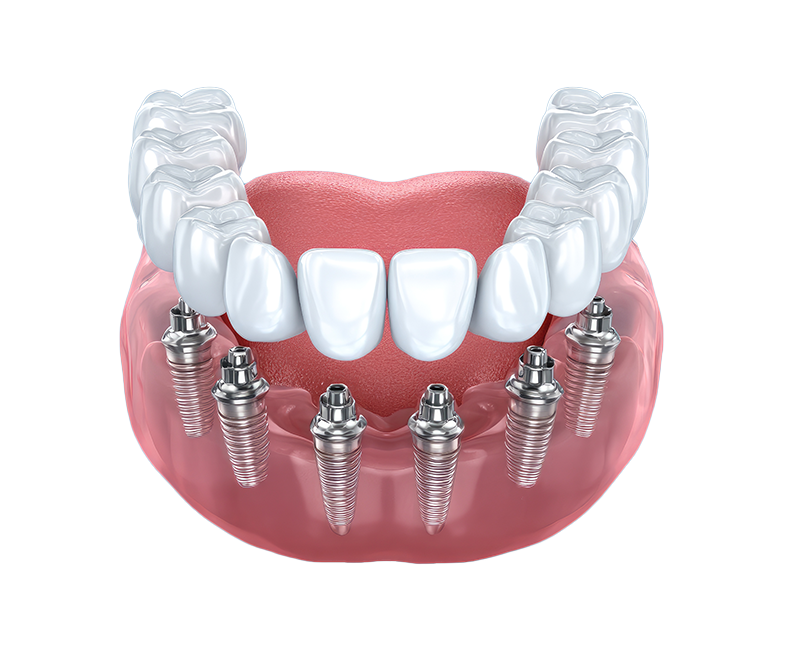 Mountain View Dentistry | Implant Restorations, Dental Cleanings and Oral Cancer Screening