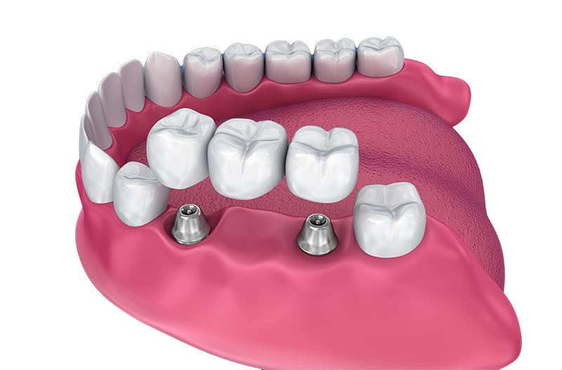 Mountain View Dentistry | Night Guards, Oral Exams and Implant Dentistry