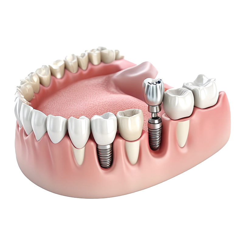 Mountain View Dentistry | Crowns  amp  Caps, Dental Bridges and Implant Restorations