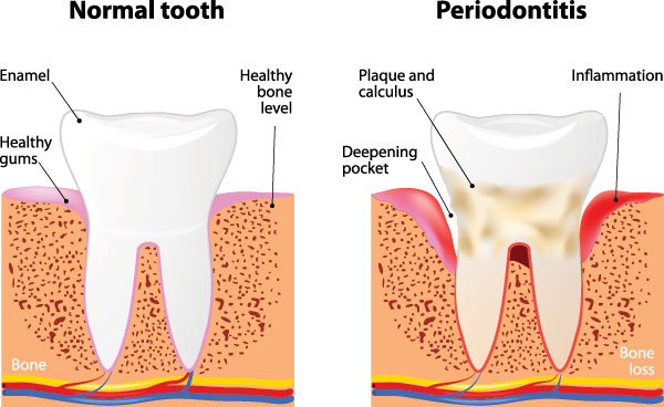 Mountain View Dentistry | Oral Cancer Screening, Implant Restorations and Oral Exams